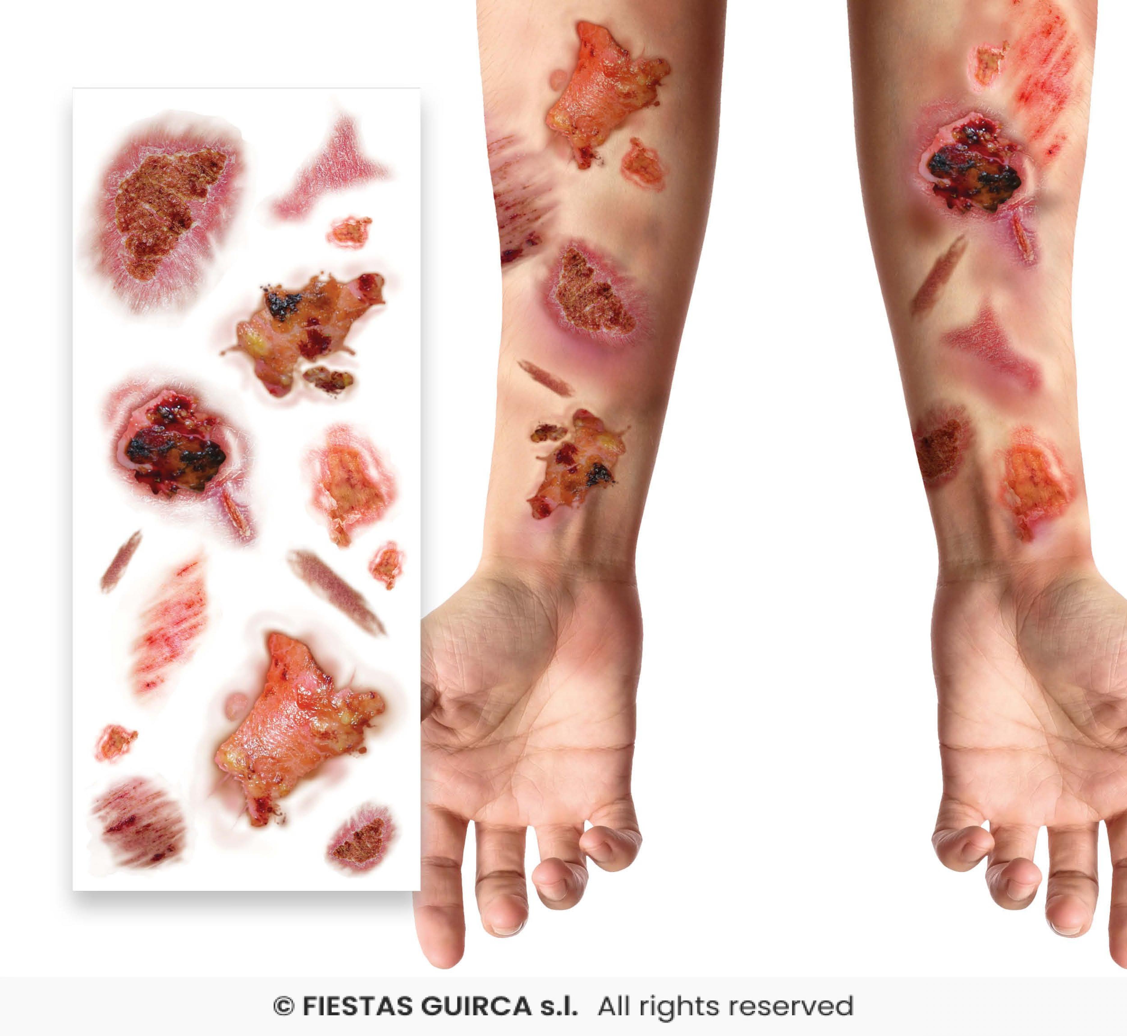 Tatouages blessures chairs à vif infectées